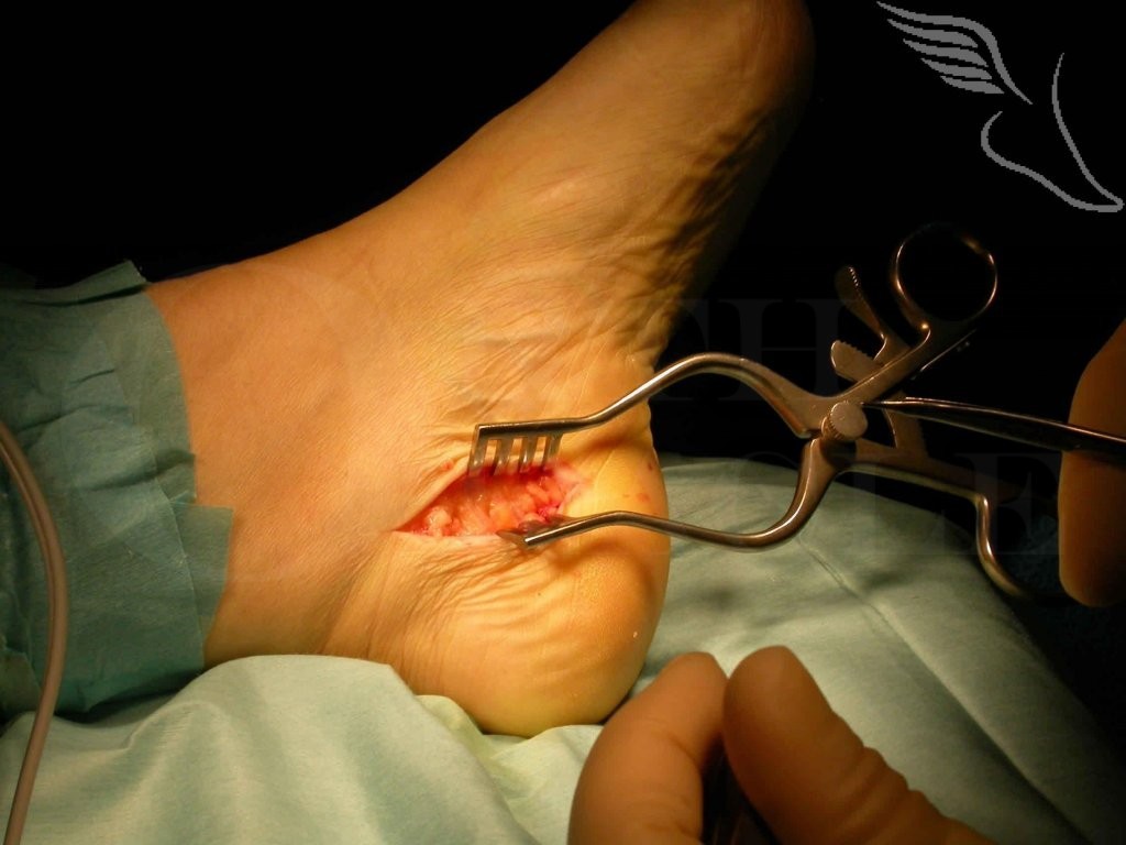 Plantar fascia release Surgical Technique OrthOracle