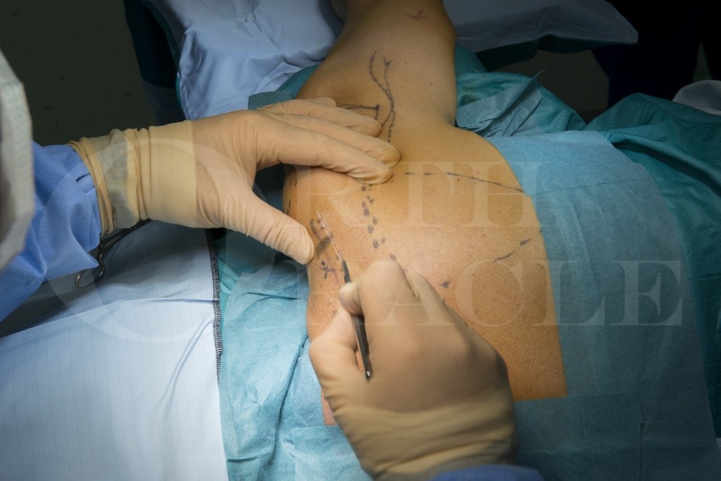 Implantation of peripheral nerve stimulator(Stimrouter neuromodulation  system) Surgical Technique - OrthOracle