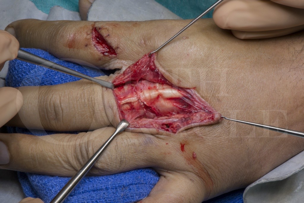 Tendon repair Information