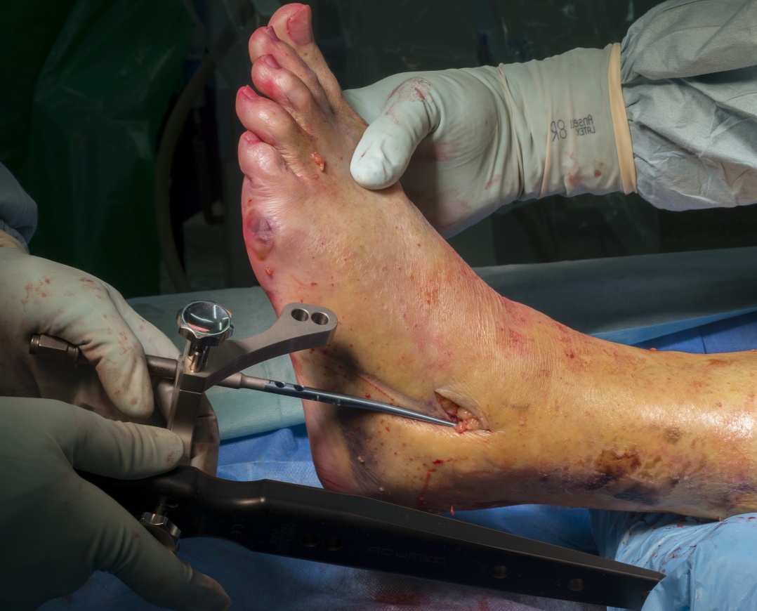 Left Ankle Fracture and Internal Fixation