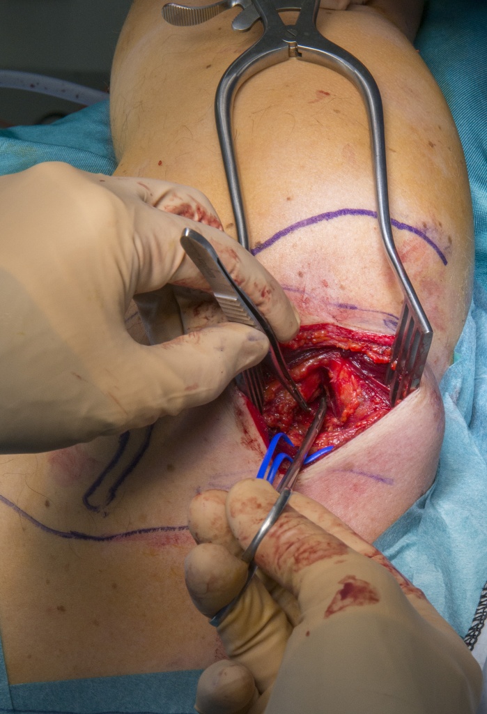 Implantation of peripheral nerve stimulator(Stimrouter neuromodulation  system) Surgical Technique - OrthOracle