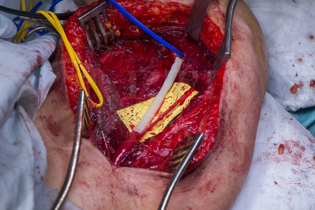 Implantation of peripheral nerve stimulator(Stimrouter neuromodulation  system) Surgical Technique - OrthOracle