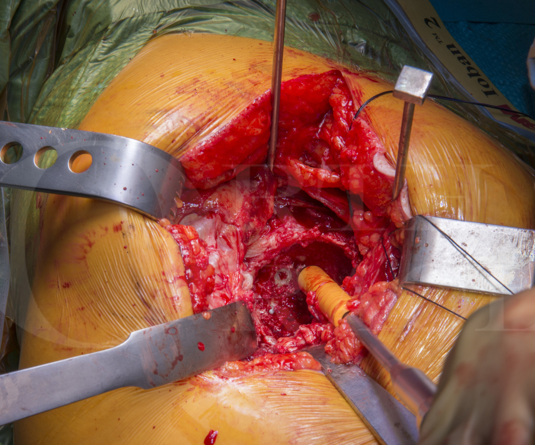 Hip Replacement Surgery, Total Hip Arthroplasty