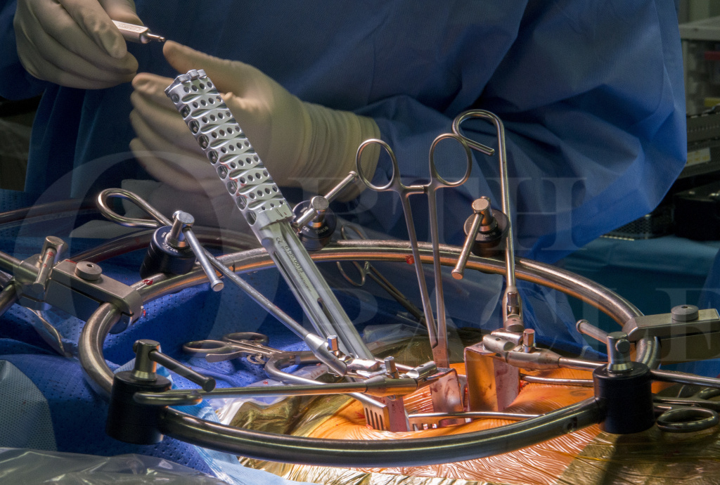 Axial Lumbar Interbody Fusion  Scottsdale, AZ Orthopedic Spine Surgery