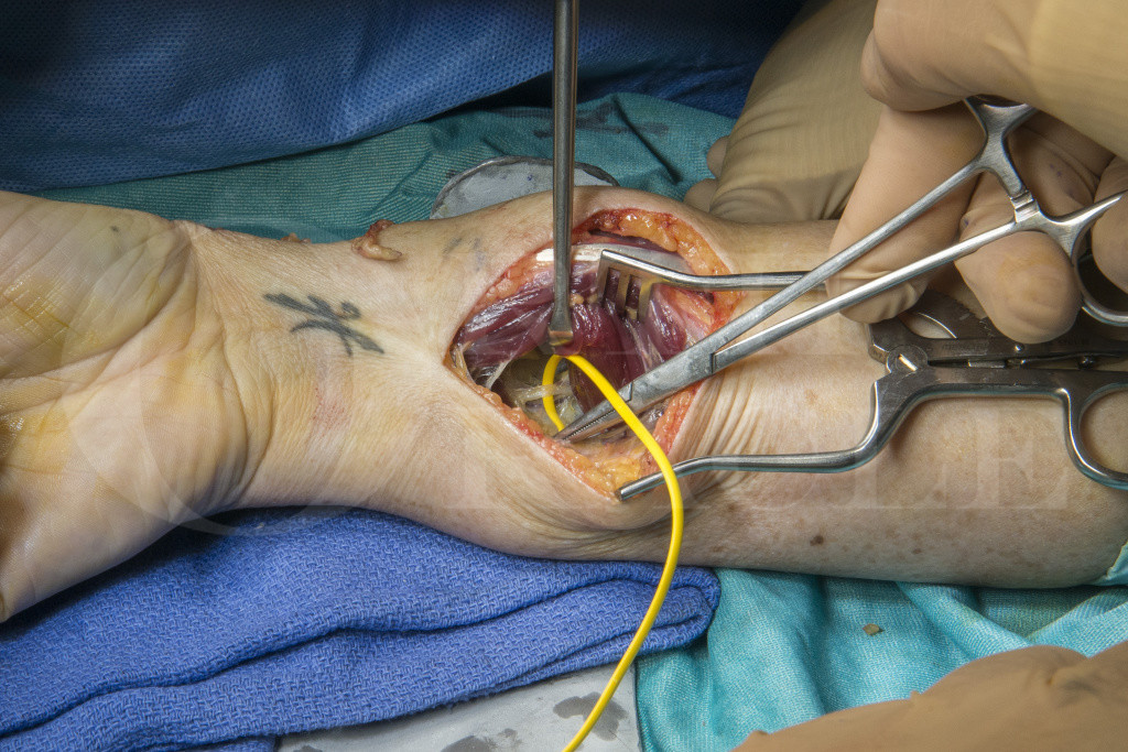 Targeted muscle re-innervation for superficial radial neuroma Surgical