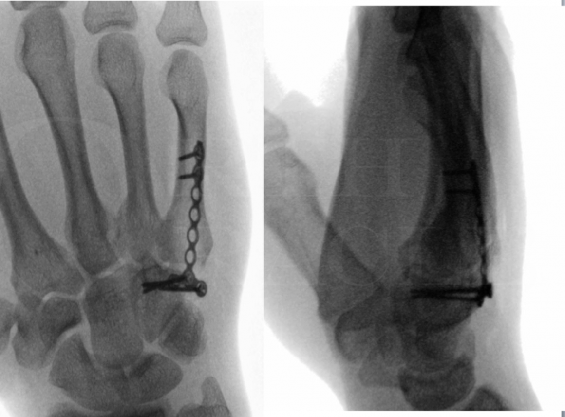 Open Reduction And Internal Fixation Of The 5th Carpometacarpal Joint 