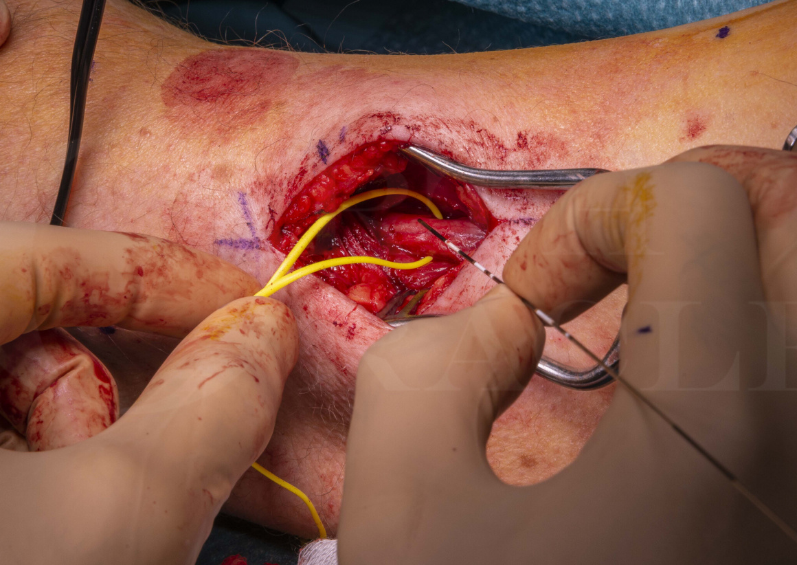 Percutaneous Electrical Nerve Stimulation and Electrical Muscle