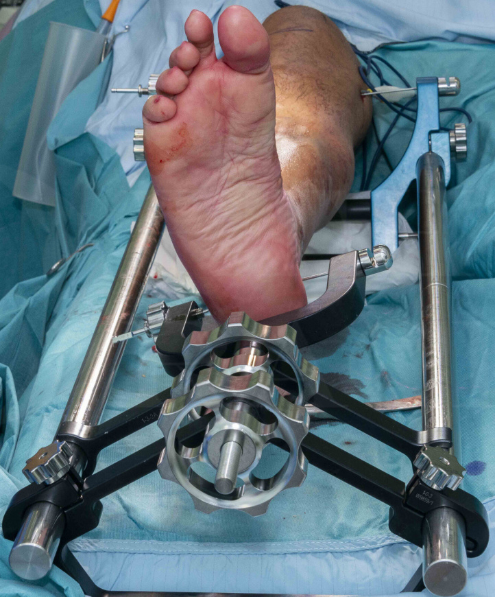 Comparison of suprapatellar intramedullary nailing versus minimal invasive  locked plating for proximal tibia fractures | Archives of Orthopaedic and  Trauma Surgery