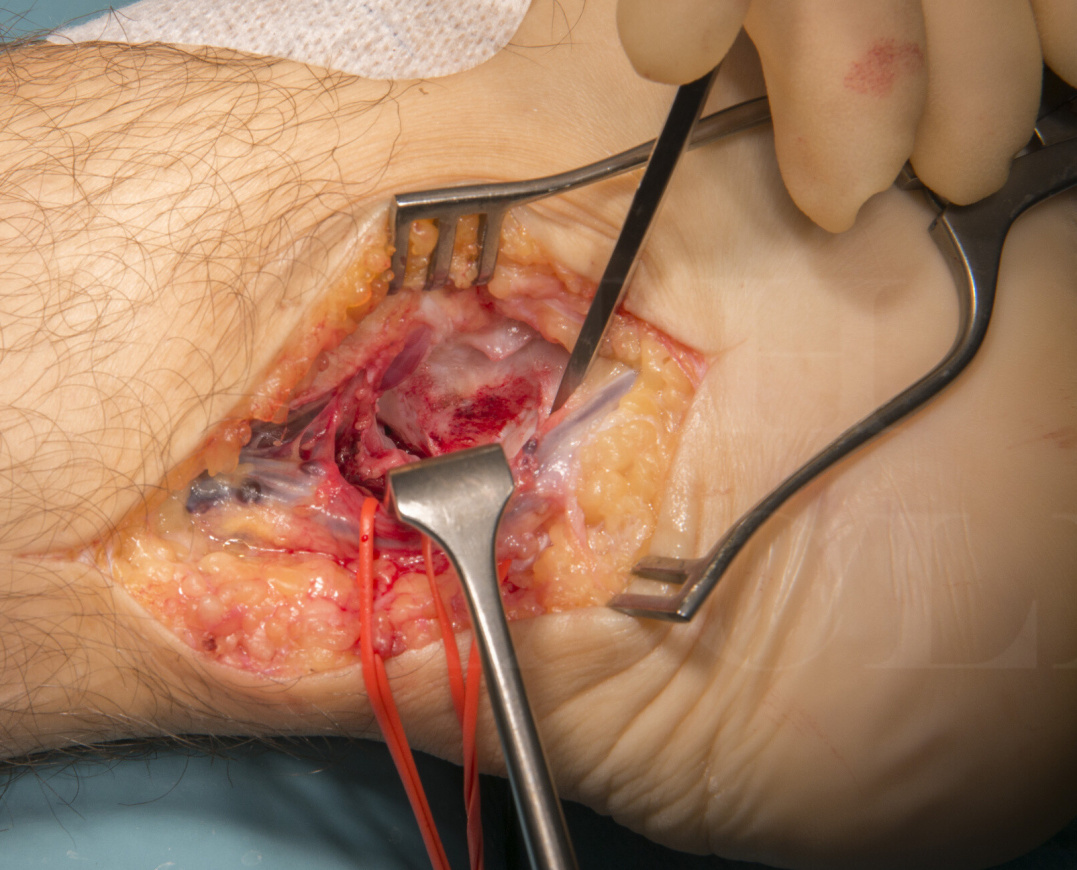 Hindfoot endoscopic release of the posterior ankle